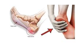 Liečba pätovej ostrohy