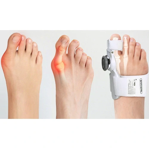 Valgus dlaha nastaviteľná Bandáž na hallux valgus